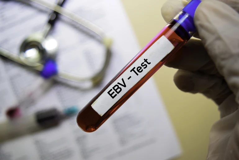 EBV вірус